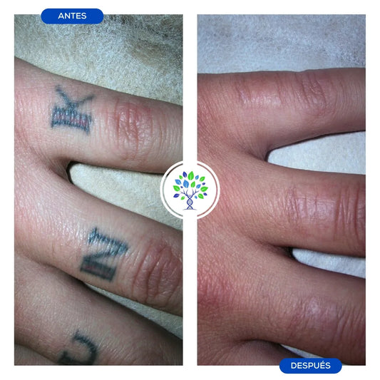 ELIMINACION DE TATUAJES BORRADO LASER (1 SESION EN SUCURSAL DE LOS ANDES)