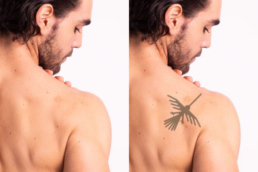 ELIMINACION DE TATUAJES BORRADO LASER (1 SESION EN SUCURSAL DE LOS ANDES)