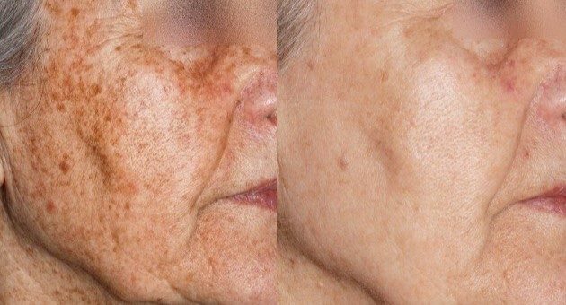 ELIMINACION DE MANCHAS Y PECAS CON LASER (1 SESION EN SUCURSAL DE LOS ANDES)