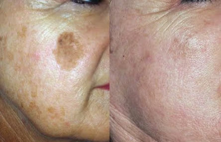 ELIMINACION DE MANCHAS Y PECAS CON LASER (1 SESION EN SUCURSAL DE LOS ANDES)