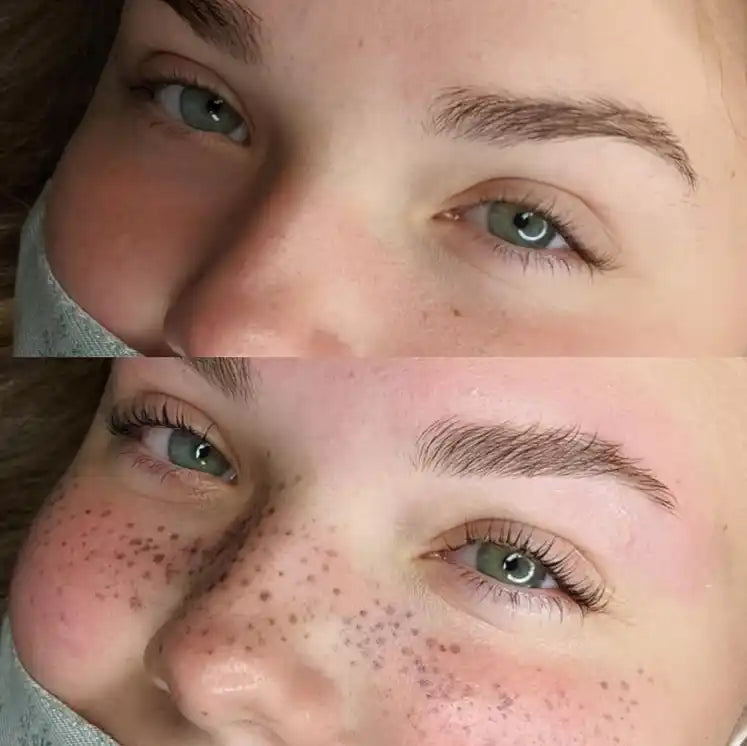 ELIMINACION DE MANCHAS Y PECAS CON LASER (1 SESION EN SUCURSAL DE LOS ANDES)