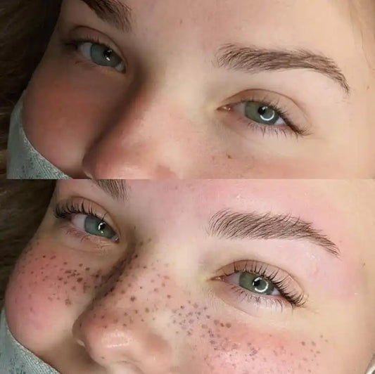 ELIMINACION DE MANCHAS Y PECAS CON LASER (1 SESION EN SUCURSAL DE LOS ANDES)