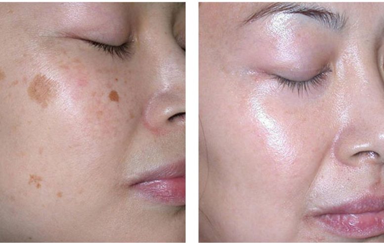 ELIMINACION DE MANCHAS Y PECAS CON LASER (1 SESION EN SUCURSAL DE LOS ANDES)